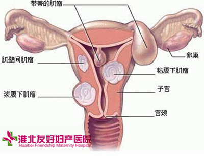 不及时治疗盆腔炎危害大