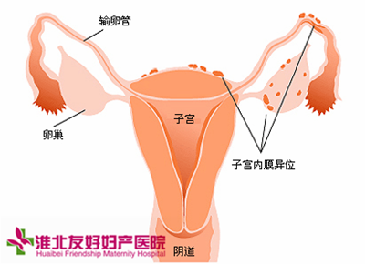 子宫内膜炎患者要做哪些检查