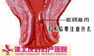 宫颈息肉应该怎样去预防?