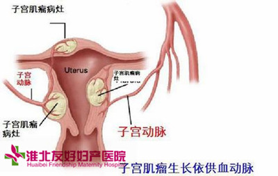 怎样得知自身患子宫肌瘤