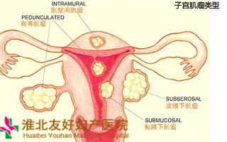 子宫肌瘤什么时候切