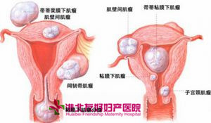 淮北治疗子宫肌瘤价格