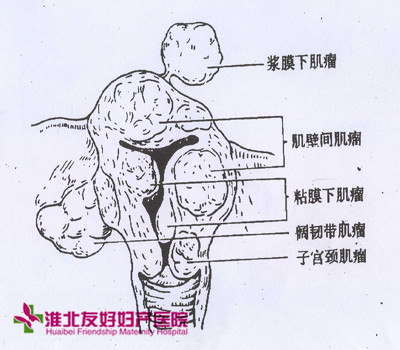 怎么检查有无子宫肌瘤