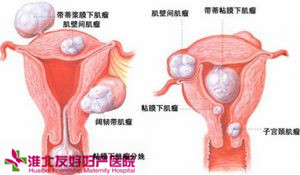 子宫肌瘤手术多少钱